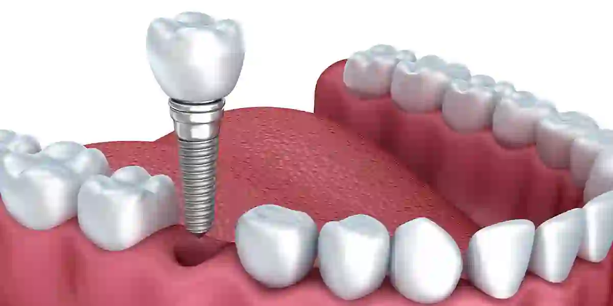 Cheap Dental Implants